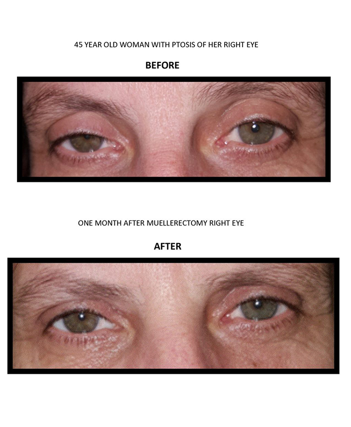 Eyelid Rejuvenation - Eye Surgeons Associates PC