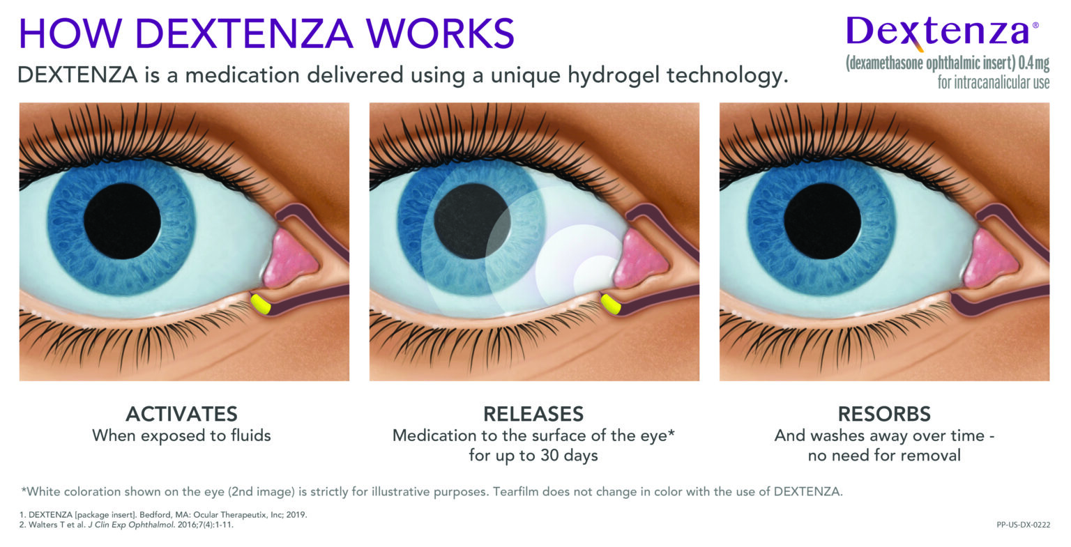 New Dextenza Reduces the Drop Regimen after Cataract